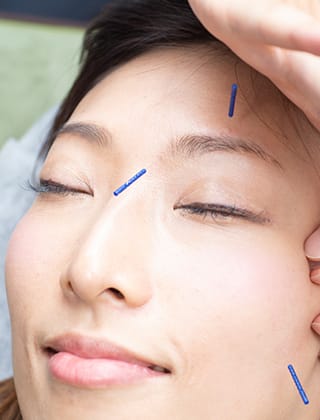 顔への鍼施術